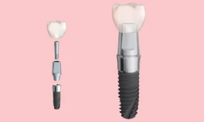 B2B Implant Fixture and Screw