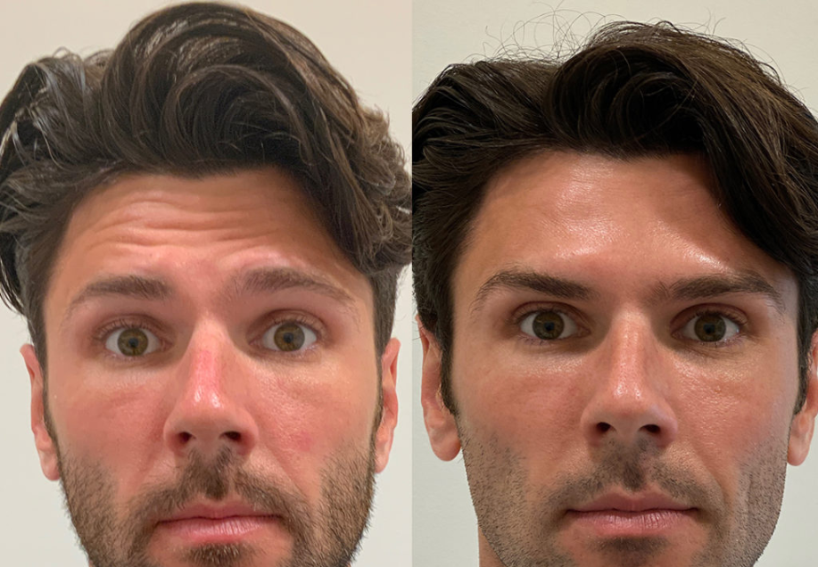 BOTOX TREATMENT